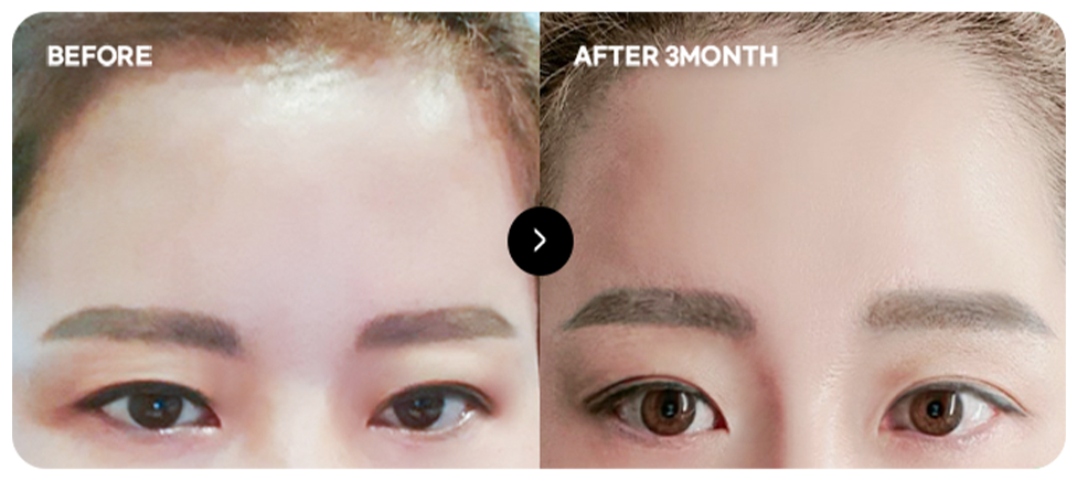 Baby-face forehead lift before and after 3