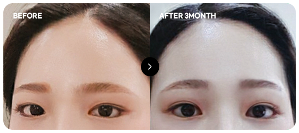 Baby-face forehead lift before and after 5