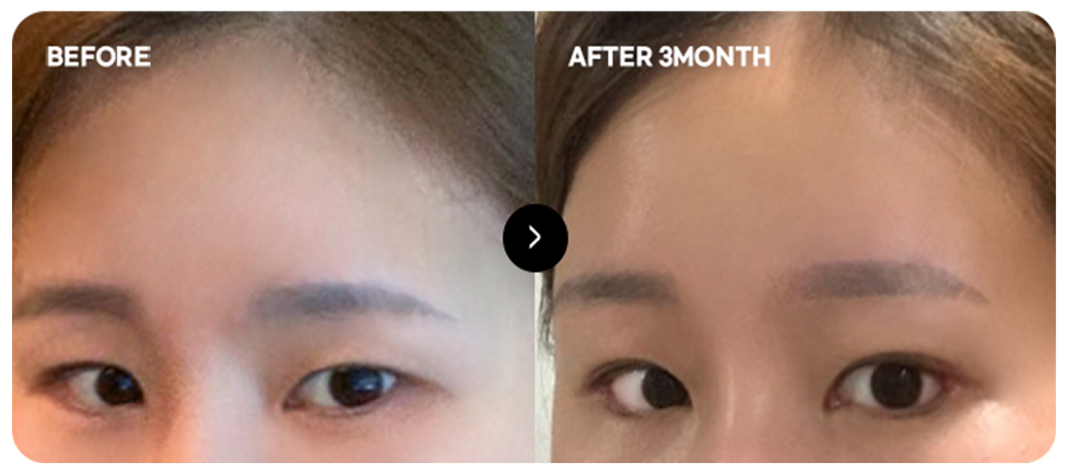 Baby-face forehead lift before and after 6