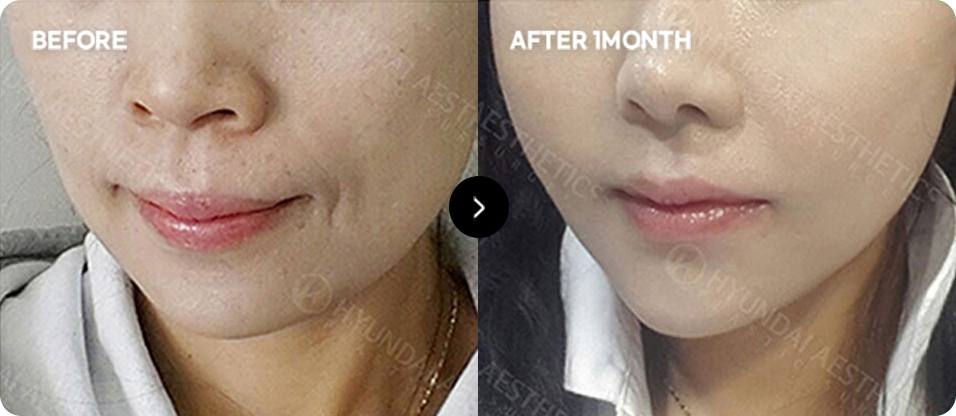 Close-contact thread lifting before and after 4