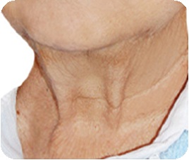 Turkey-wattle type neck wrinkles - vertically sagging neck wrinkles