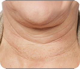 Growth-ring type neck wrinkles - horizontally extended neck wrinkles