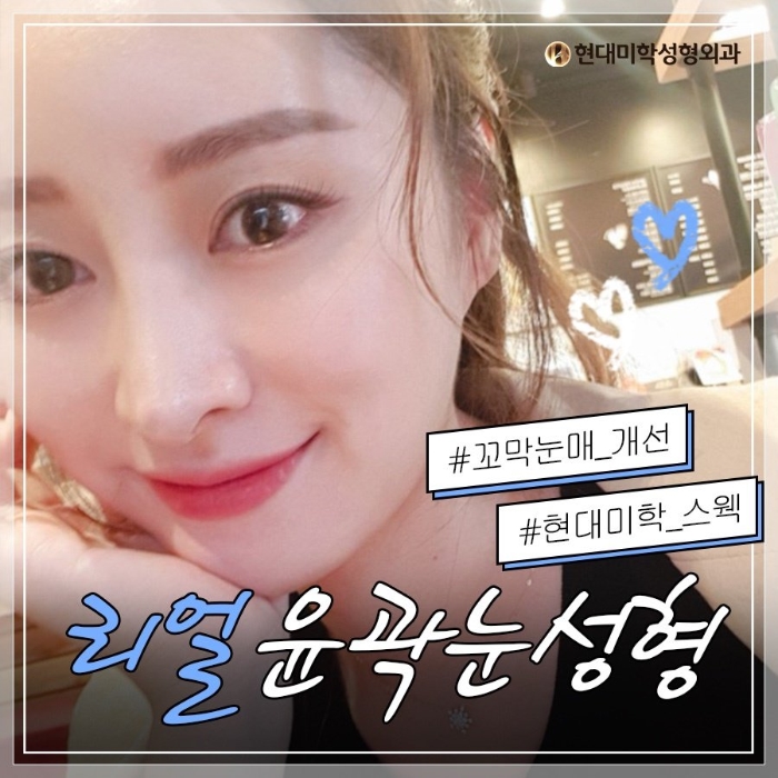 Successful completion by a lateral canthoplasty plastic surgery clinic