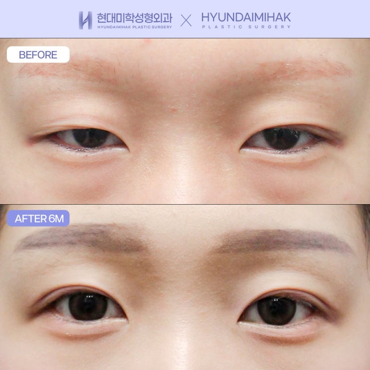 Incisional Ptosis Correction Surgery for Easier Eye Opening