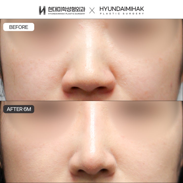 Natural-Looking Rhinoplasty: Which Material Is Best?