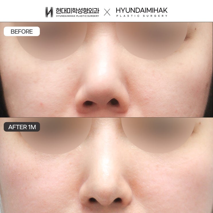 Before and After Upturned Nose Surgery: A Case of Lowering the Columella