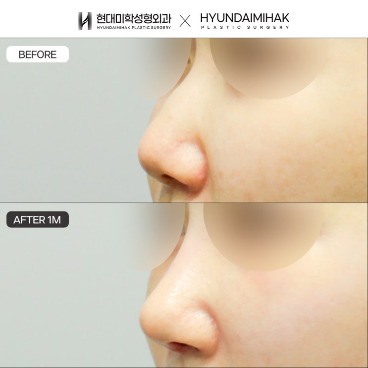 What effective ways are there to make the nasal bridge higher?