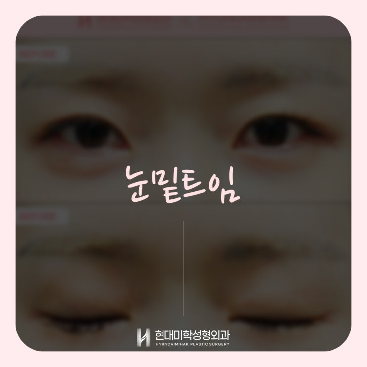 A trusted clinic for lower eyelid opening surgery: natural eye-shape changes at Hyundai Aesthetic Surgery