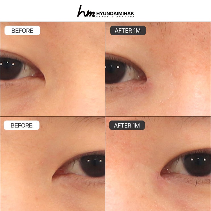 Key Information You Need to Know to Be Satisfied with Both Epicanthoplasty Revision Cost and Results