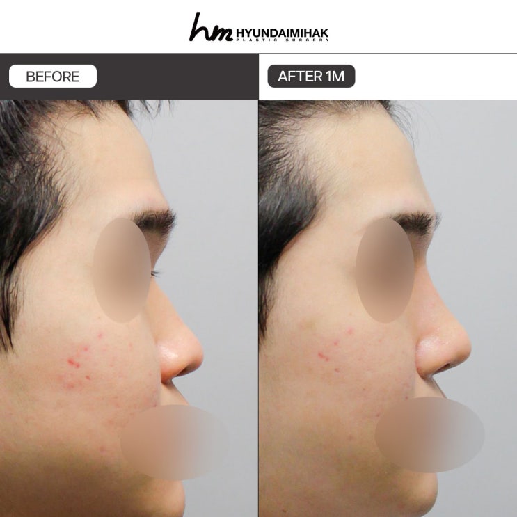 Male Rhinoplasty Clinic: The First Step Toward Changing Your First Impression