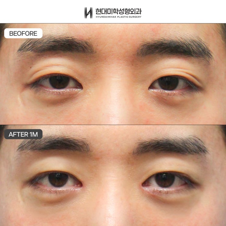 Male Ptosis Correction Reviews: If You Want a Clear Before-and-After Change