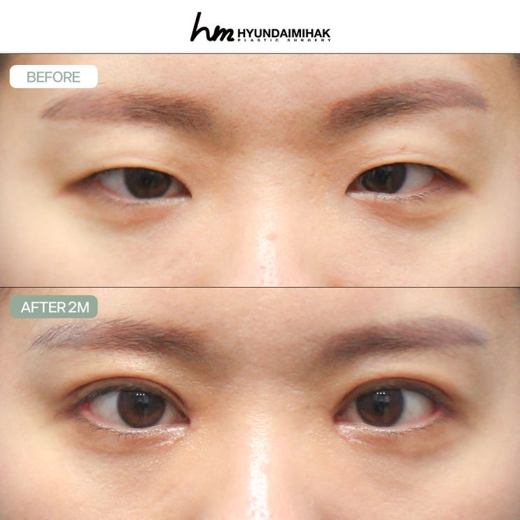 How Hyundai Aesthetic Surgery in Gangnam Creates Beautiful Eyes Without Worrying About Revision Surgery