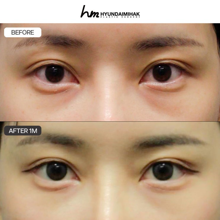 Conditions for Successful Dual Canthoplasty Without Wasting Money