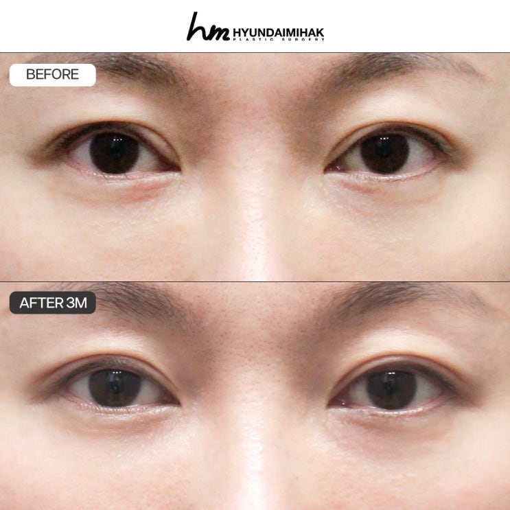 Revision Ptosis Correction: A Safety Guide from Hyundai Aesthetic Surgery