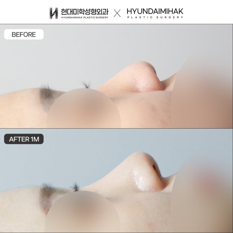 Key Considerations When Choosing a Clinic Skilled in Rhinoplasty