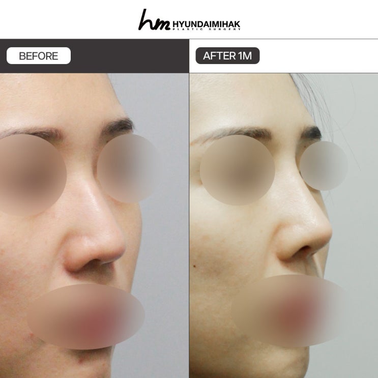 Essential Things to Know Before a Rhinoplasty Consultation