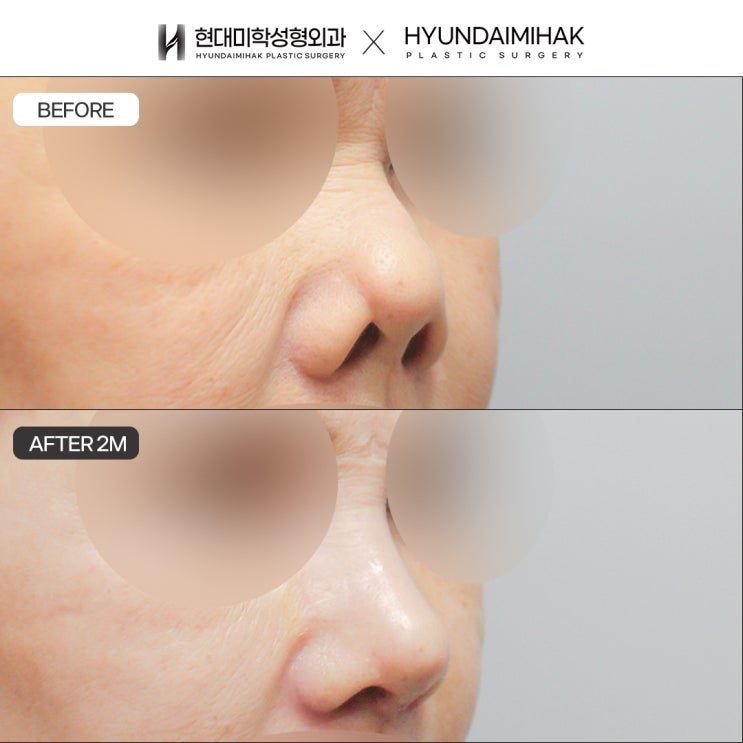 Contracted Nose Revision Review: It Could Be an Implant Issue