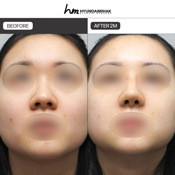 Before and After Bulbous Nose Surgery: The Secret to a Natural, Refined Impression | Hyundai Aesthetic Surgery’s Expertise in Bulbous Nose Correction