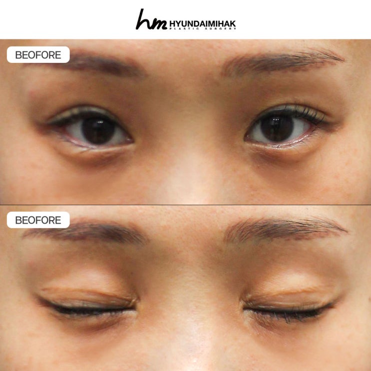 Revision Eye Surgery: A Different Approach Starting with Double-Eyelid Line Selection