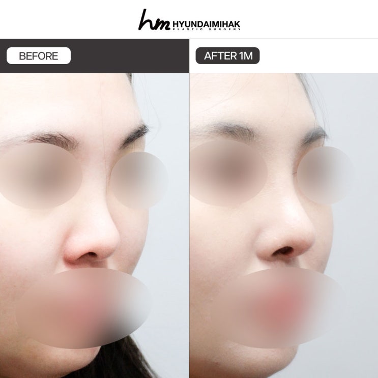 The Secret to Correcting a Short Nose for a Changed Impression