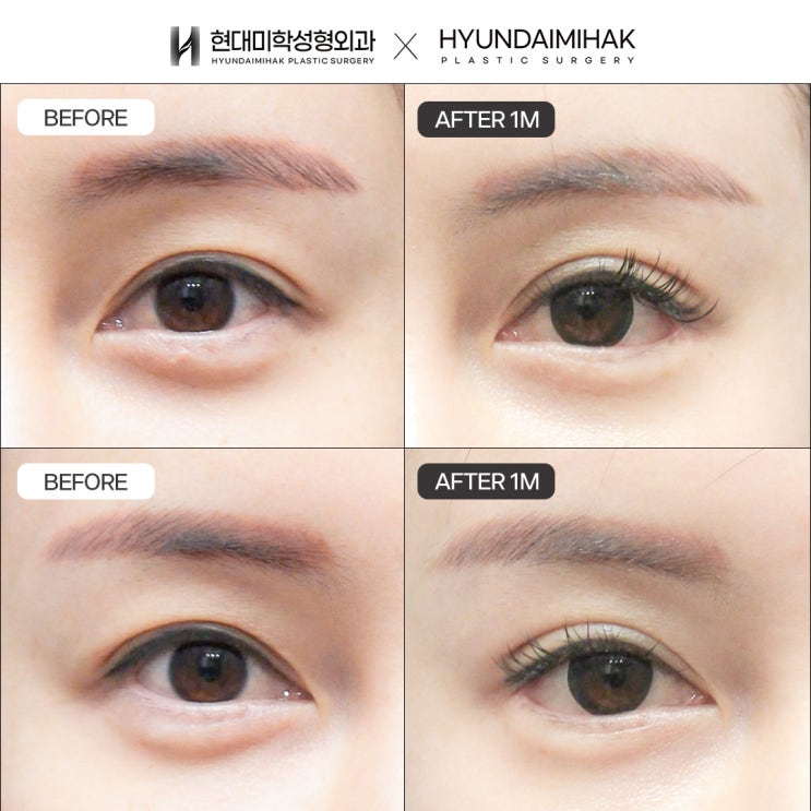 Epicanthoplasty and canthoplasty to extend the length of the eyes