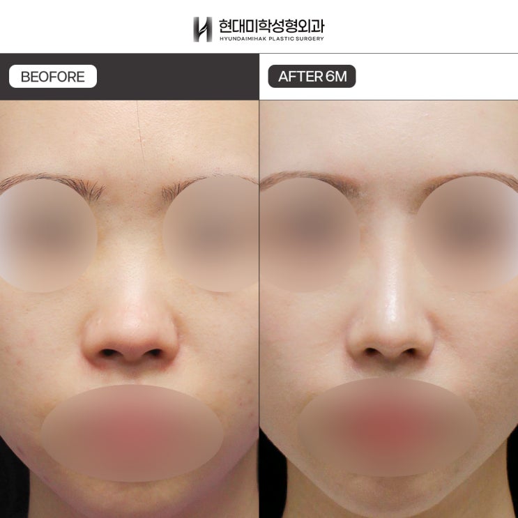 Low Nose Surgery Cost: Depending on Materials and Procedure Items