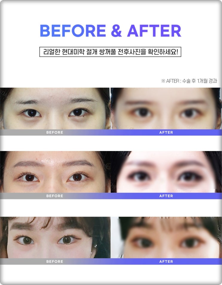 Can double eyelid surgery be successful without the crease coming undone?
