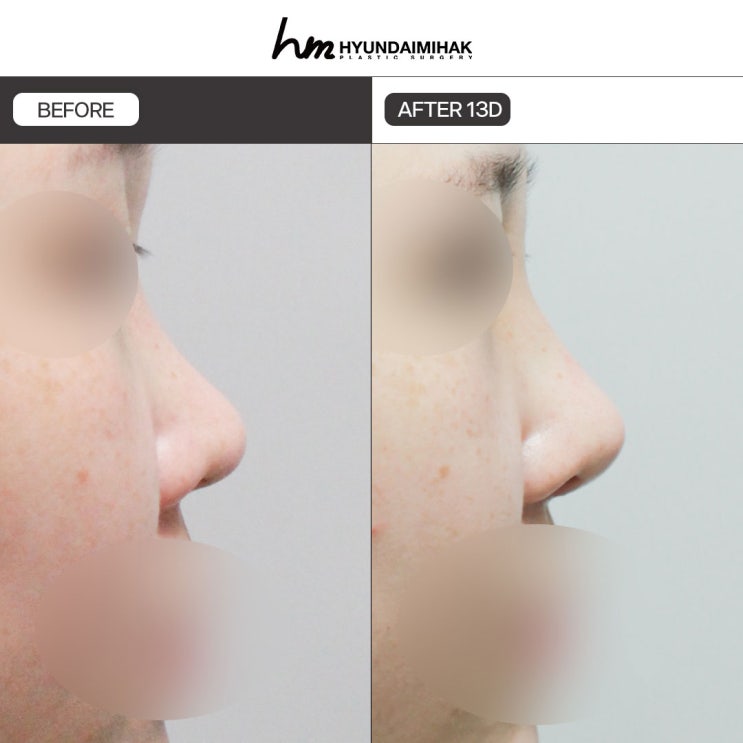 Short Nose Surgery: Completing a Refined Side Profile