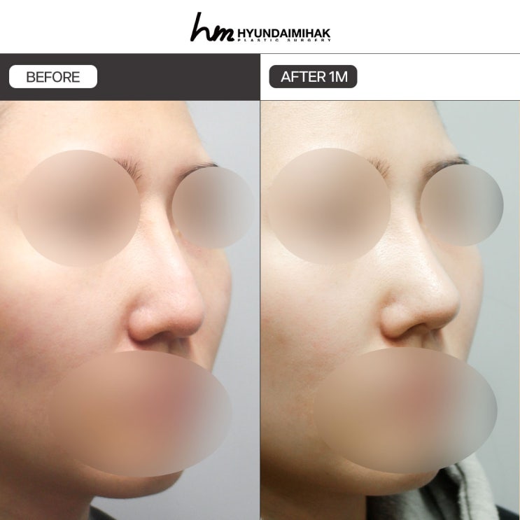 Nasolabial Angle Surgery: The Key to Balanced Facial Improvement