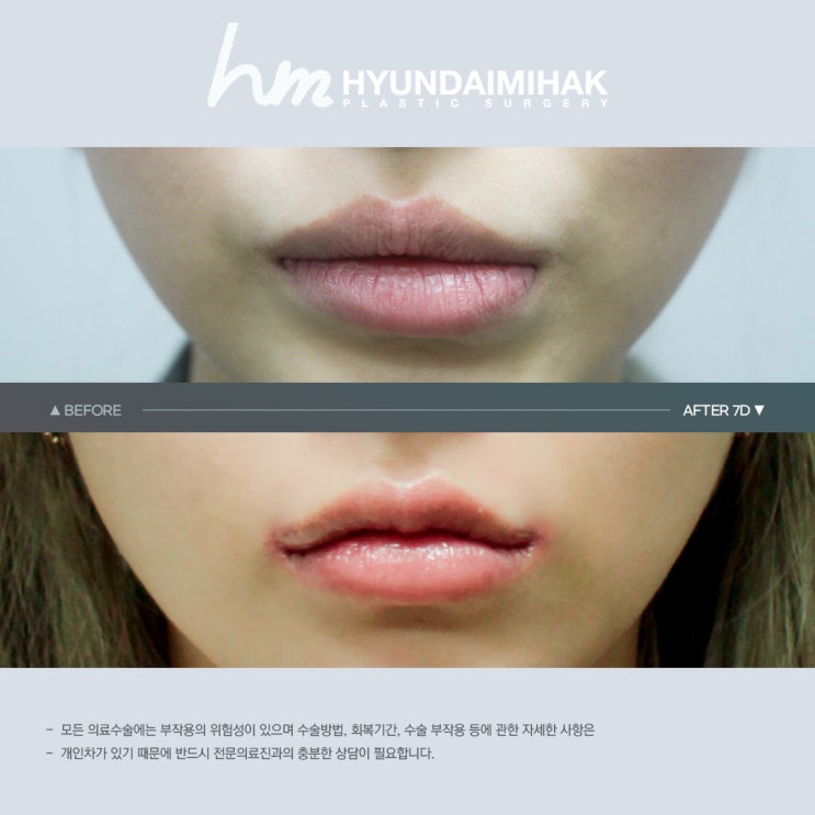 Essential Guide to Choosing Mouth Corner Surgery Cost Without Regret