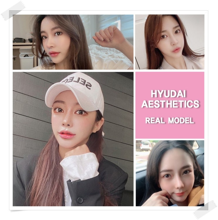 Double Eyelid Surgery Review: A Line with Character