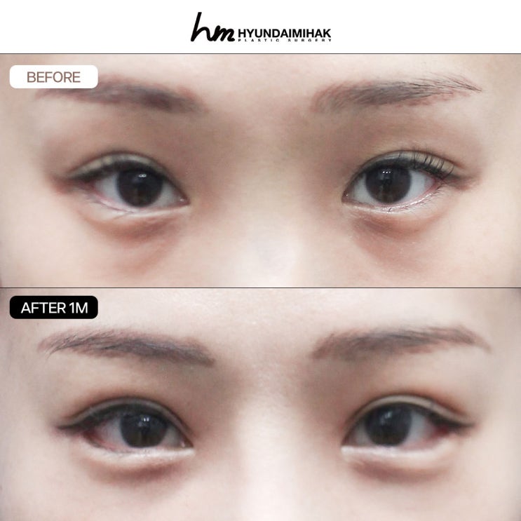 If you want to naturally soften an awkward impression at a revision rhinoplasty clinic