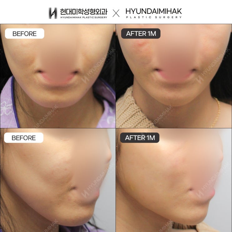 Thread Lifting Clinic: Fast and Effective Skin Improvement
