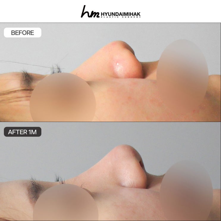 Choosing the right rhinoplasty clinic can completely change your facial image