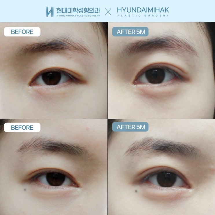 If You Want a Difference, Choose a Clinic Skilled in Ptosis Correction