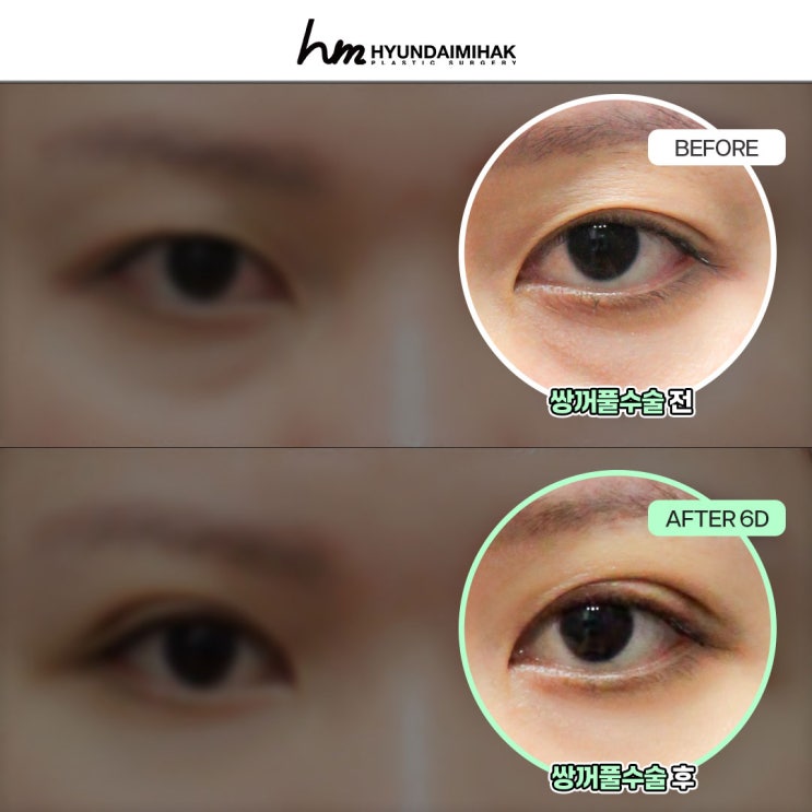 Gangnam Eye Surgery Clinic: A Guide to Choosing From Your First Surgery to Revision Surgery
