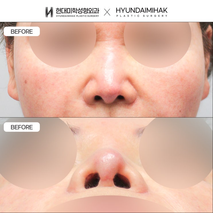 Short Nose Revision Surgery When Contracture Is the Cause