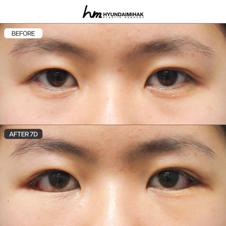 How to Reduce Side Effects After Epicanthoplasty and Canthoplasty|Hyundai Aesthetic Surgery Guide