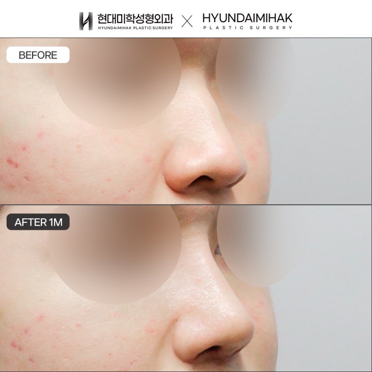 Gangnam Male Rhinoplasty: Understand It Properly Before Planning