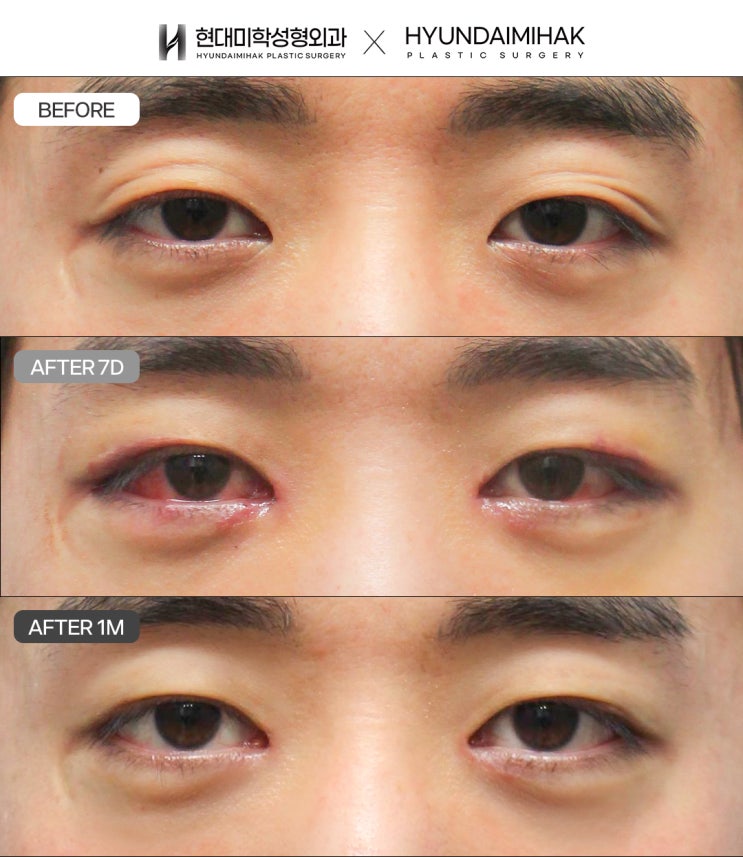 Male Monolid Ptosis Correction: Changing a Sleepy Impression