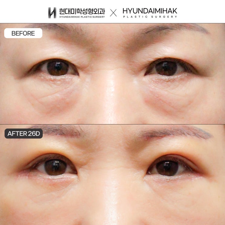 Upper Blepharoplasty Cost for Age-Related Drooping Eyes