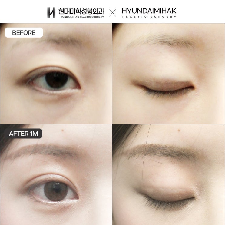 Restoring a natural eye shape through careful decision-making for incisional double-eyelid revision surgery