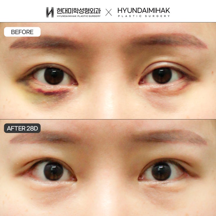 Why Comparing the Cost of Incisional Ptosis Correction and Making the Right Choice Matters