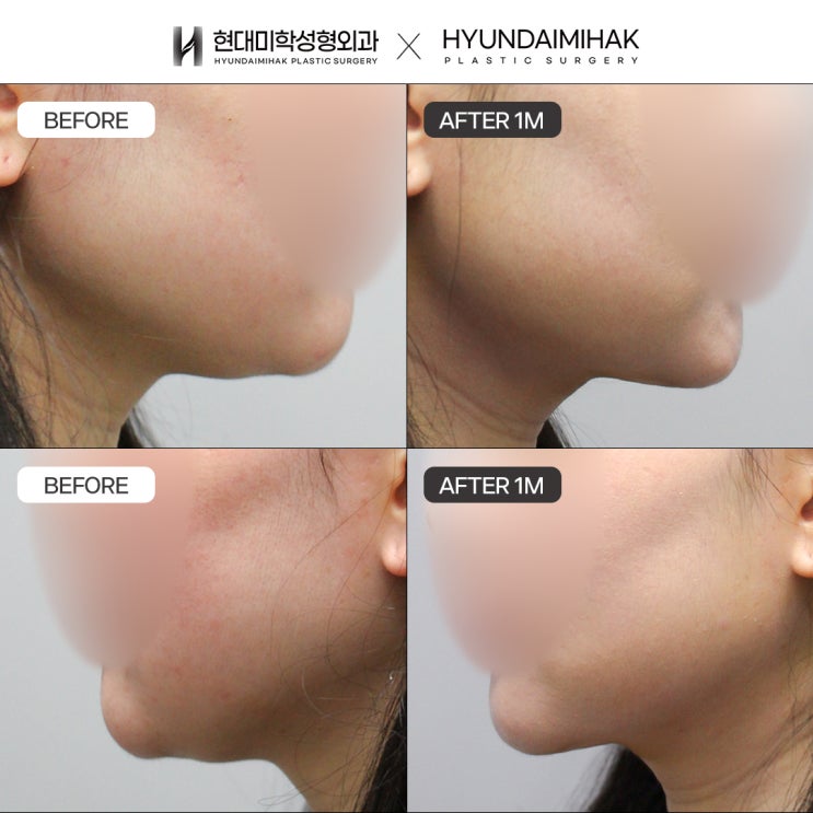 How to Resolve Double Chin Concerns with Two-Chin Lifting