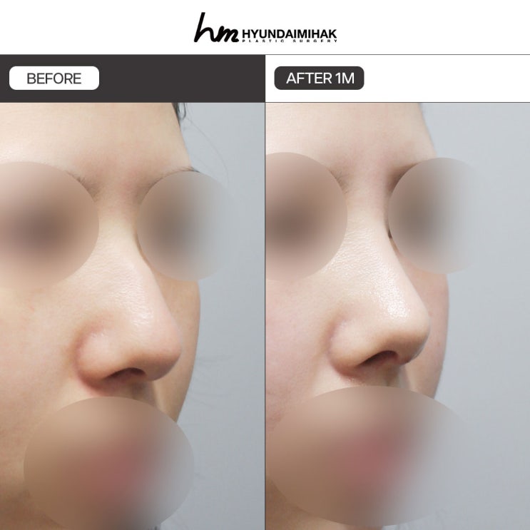 Hyundai Aesthetic Surgery’s Guide to Choosing Hump Nose Surgery