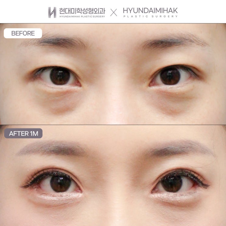 Cases Suitable for Natural Adhesion Suture Double Eyelid Surgery