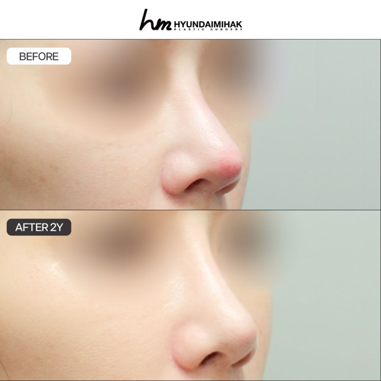 Nasal Silicone Showing Through: Conditions for a Safe and Beautiful Nose