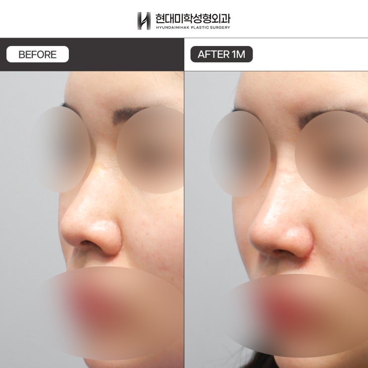 Advantages of donated costal cartilage mentioned in reviews of donated rib cartilage rhinoplasty