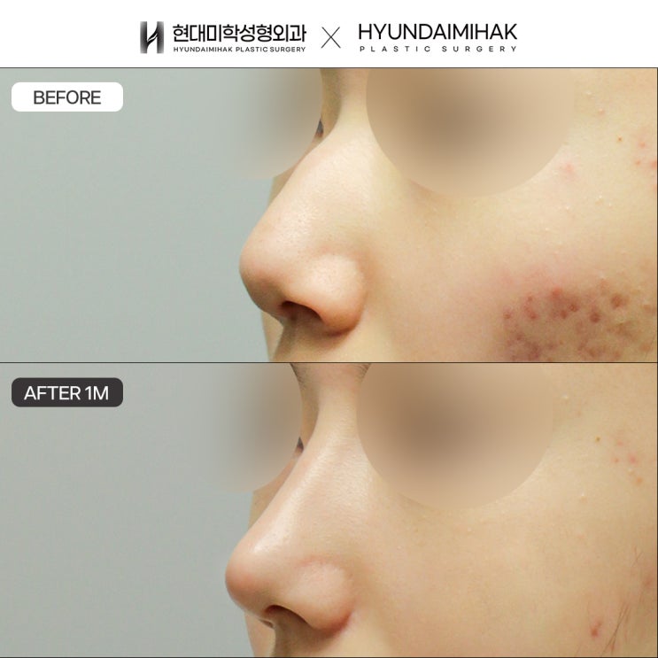 Gangnam Hump Nose Surgery for a Softer Image