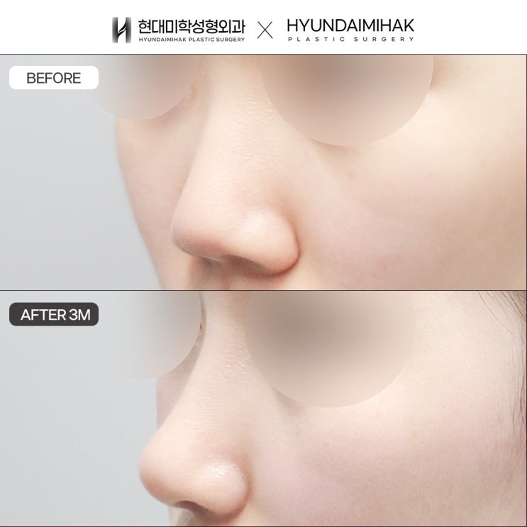 Recommended Rhinoplasty Clinic: Building a Confident Appearance After the College Entrance Exam